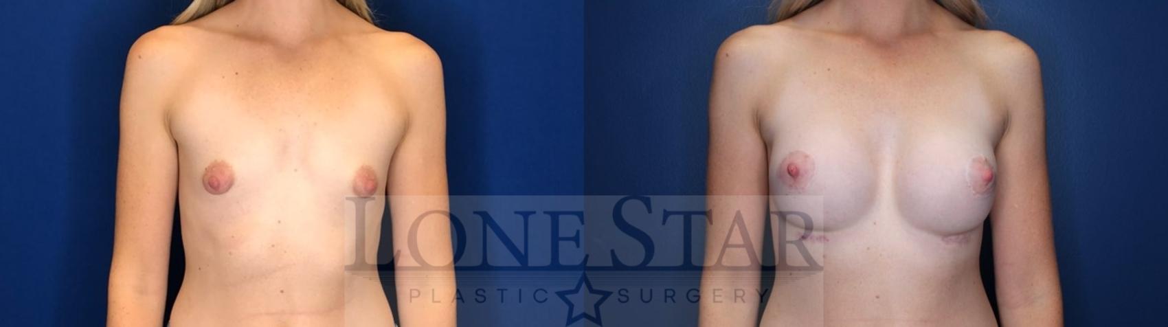 Before & After Breast Augmentation Case 120 Front View in Frisco, TX