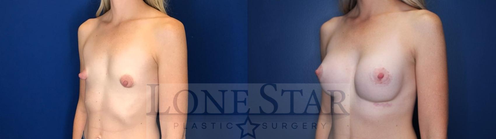 Before & After Breast Augmentation Case 120 Left Oblique View in Frisco, TX