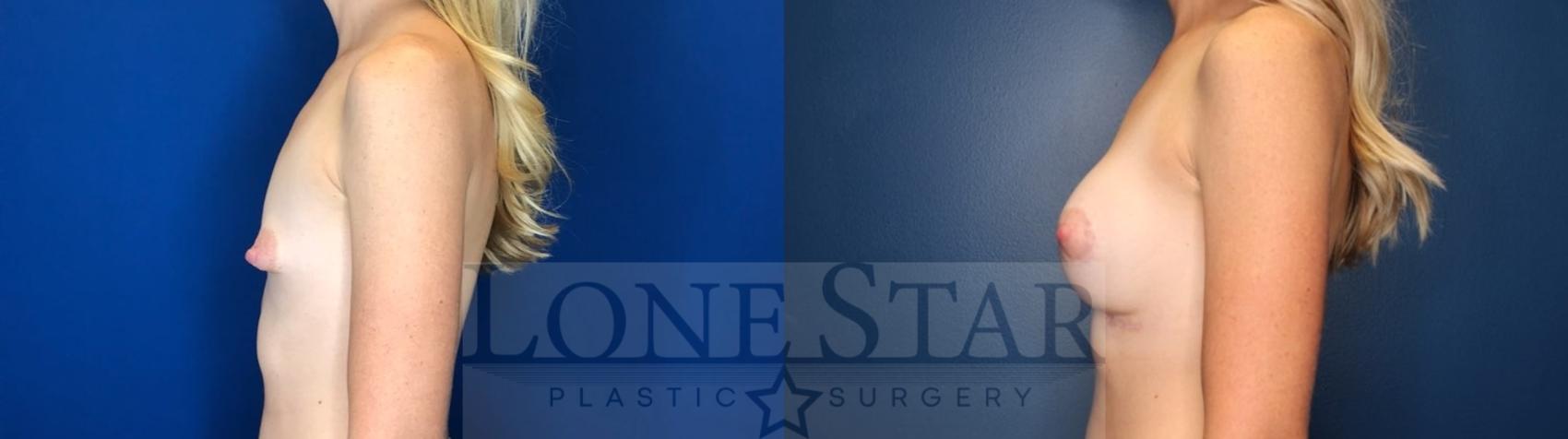 Before & After Breast Augmentation Case 120 Left Side View in Frisco, TX