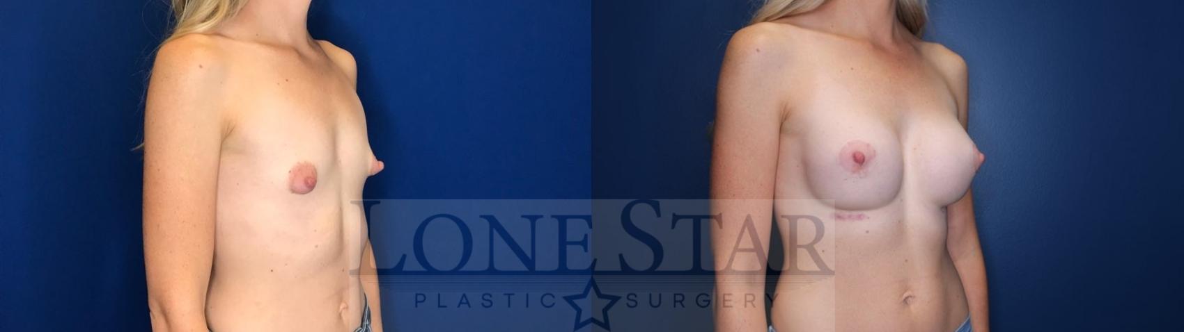 Before & After Breast Augmentation Case 120 Right Oblique View in Frisco, TX