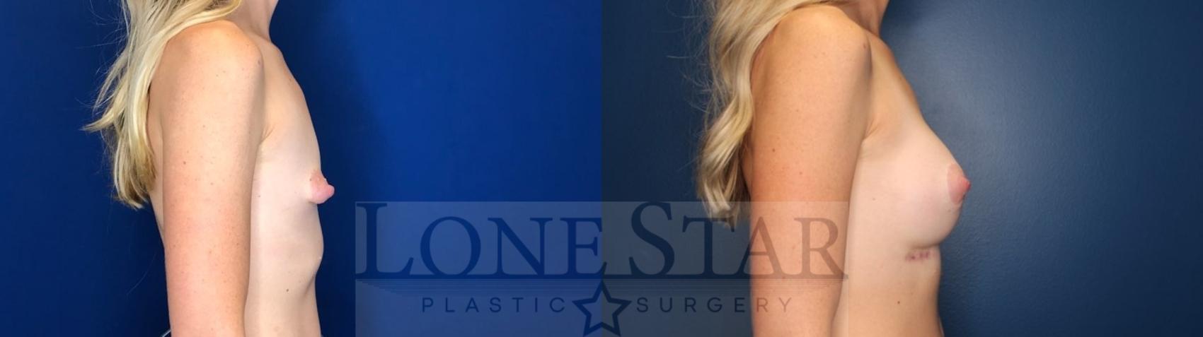 Before & After Breast Augmentation Case 120 Right Side View in Frisco, TX