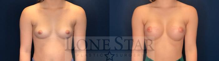Before & After Breast Augmentation Case 122 Front View in Frisco, TX