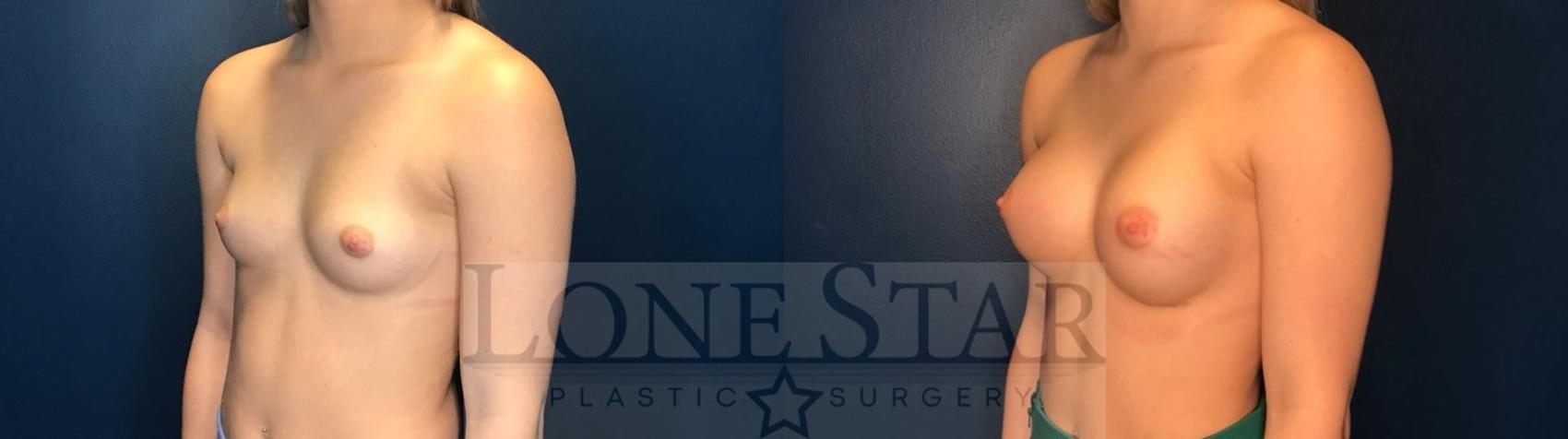 Before & After Breast Augmentation Case 122 Left Oblique View in Frisco, TX