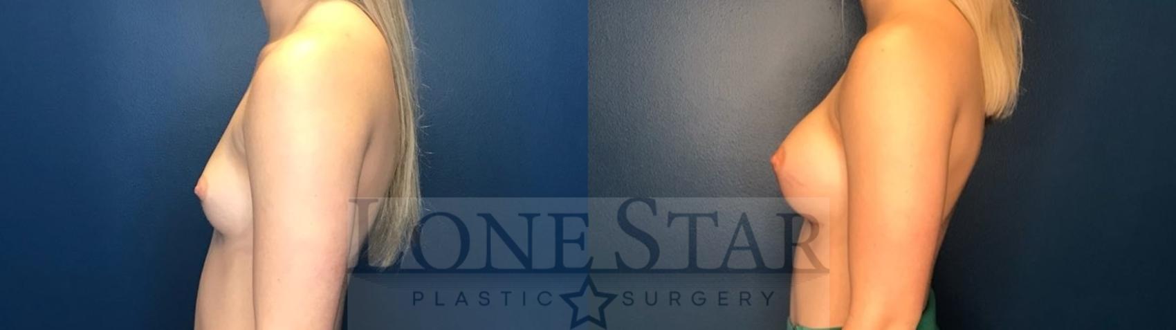 Before & After Breast Augmentation Case 122 Left Side View in Frisco, TX