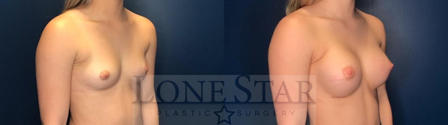 Before & After Breast Augmentation Case 122 Right Oblique View in Frisco, TX