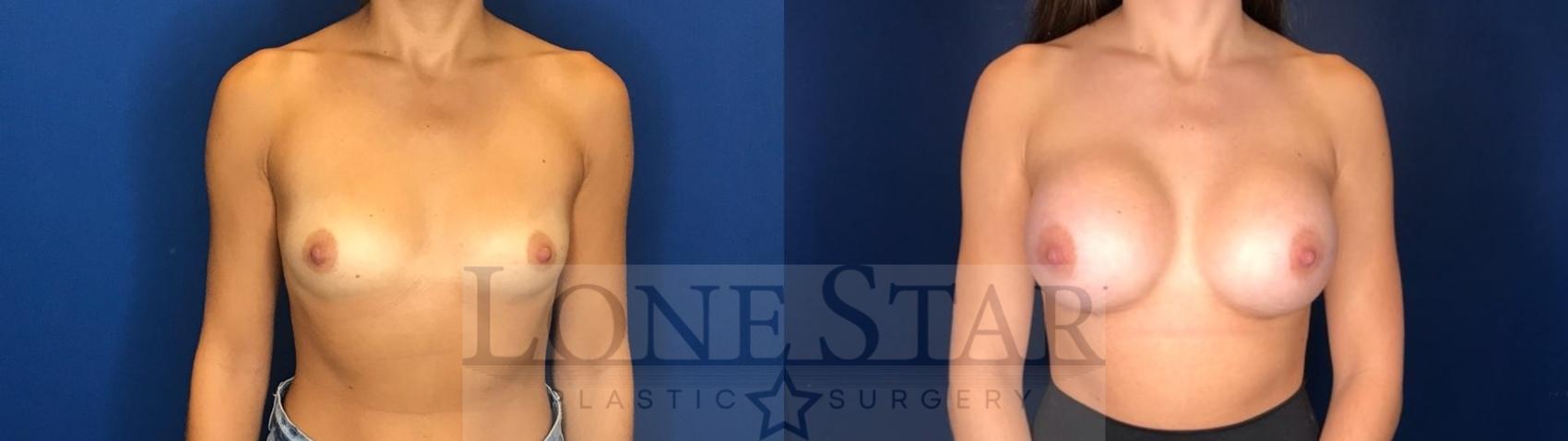 Before & After Breast Augmentation Case 123 Front View in Frisco, TX