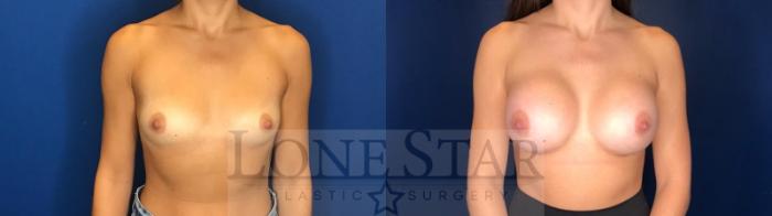 Before & After Breast Augmentation Case 123 Front View in Frisco, TX