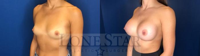 Before & After Breast Augmentation Case 123 Left Oblique View in Frisco, TX