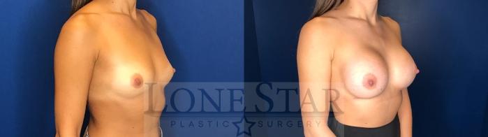 Before & After Breast Augmentation Case 123 Right Oblique View in Frisco, TX