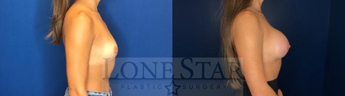 Before & After Breast Augmentation Case 123 Right Side View in Frisco, TX
