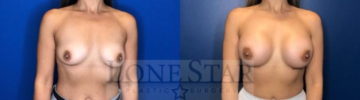 Before & After Breast Augmentation Case 124 Front View in Frisco, TX