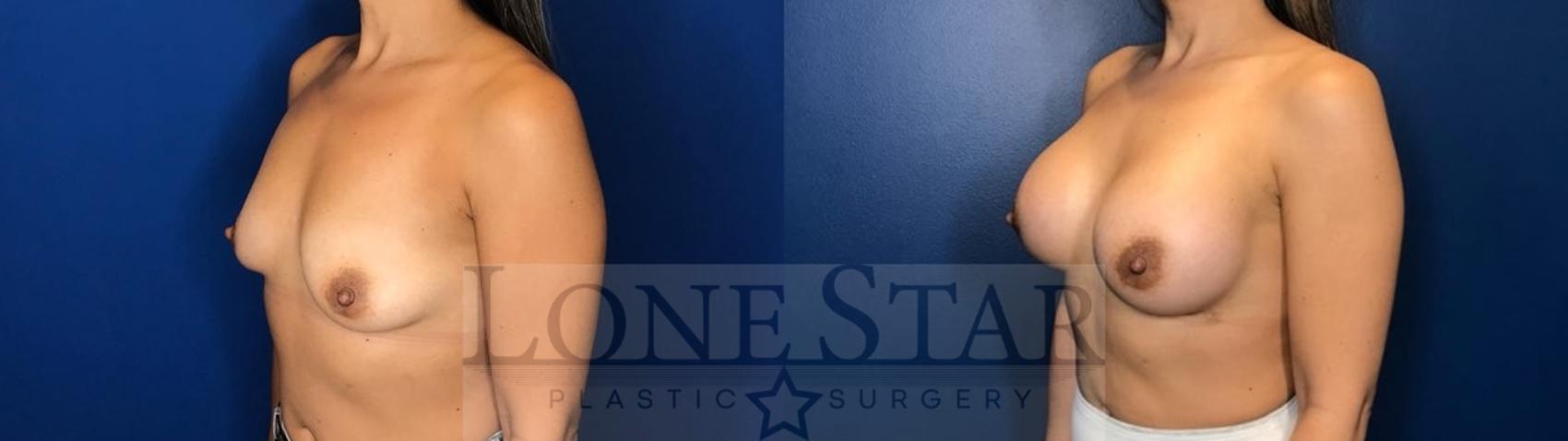 Before & After Breast Augmentation Case 124 Left Oblique View in Frisco, TX