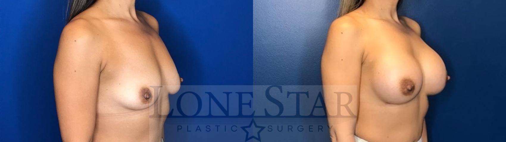 Before & After Breast Augmentation Case 124 Right Oblique View in Frisco, TX