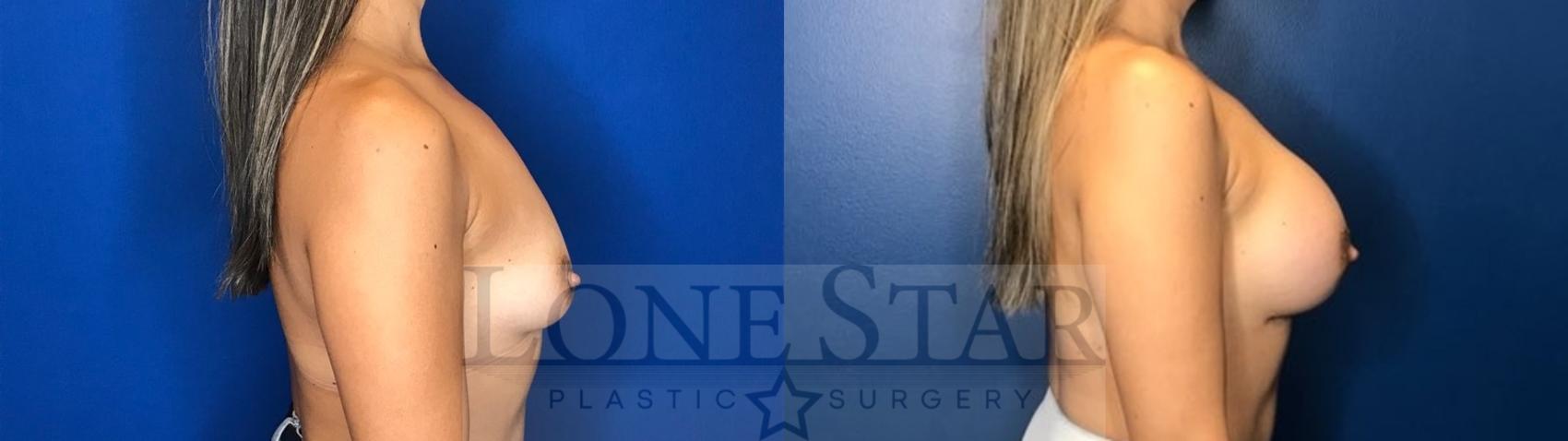 Before & After Breast Augmentation Case 124 Right Side View in Frisco, TX