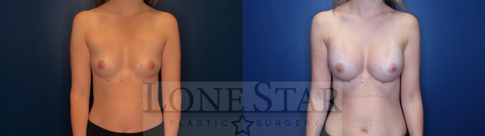 Before & After Breast Augmentation Case 126 Front View in Frisco, TX