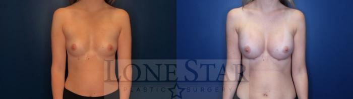 Before & After Breast Augmentation Case 126 Front View in Frisco, TX