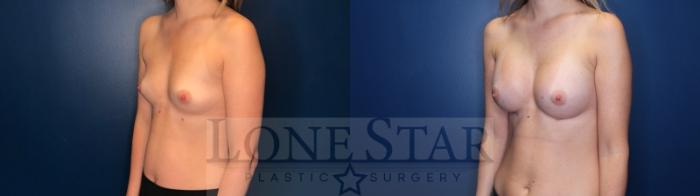 Before & After Breast Augmentation Case 126 Left Oblique View in Frisco, TX