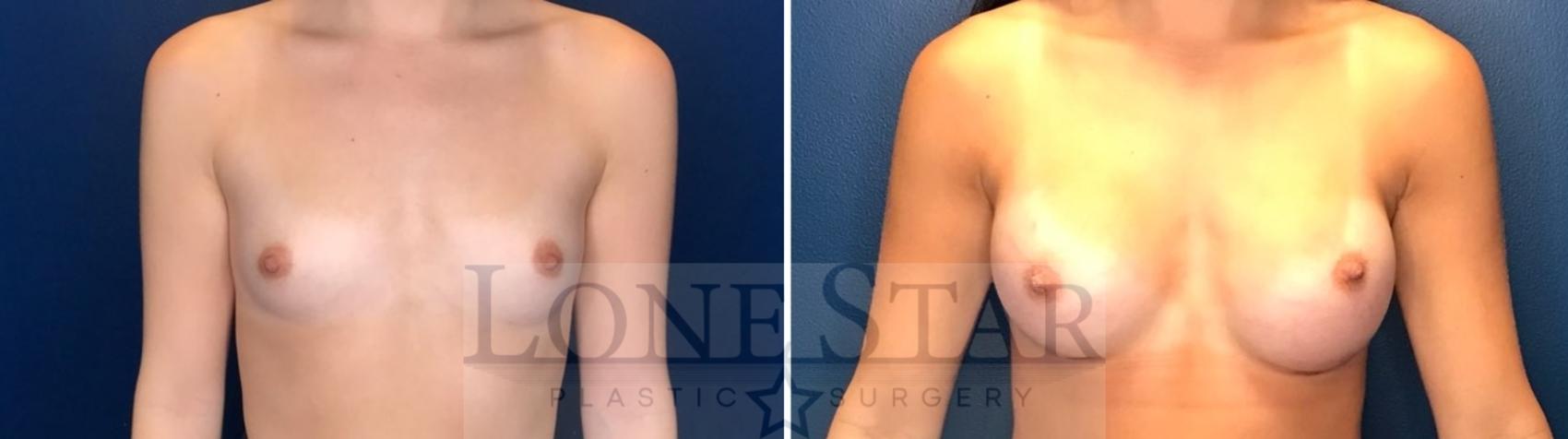 Before & After Breast Augmentation Case 128 Front View in Frisco, TX