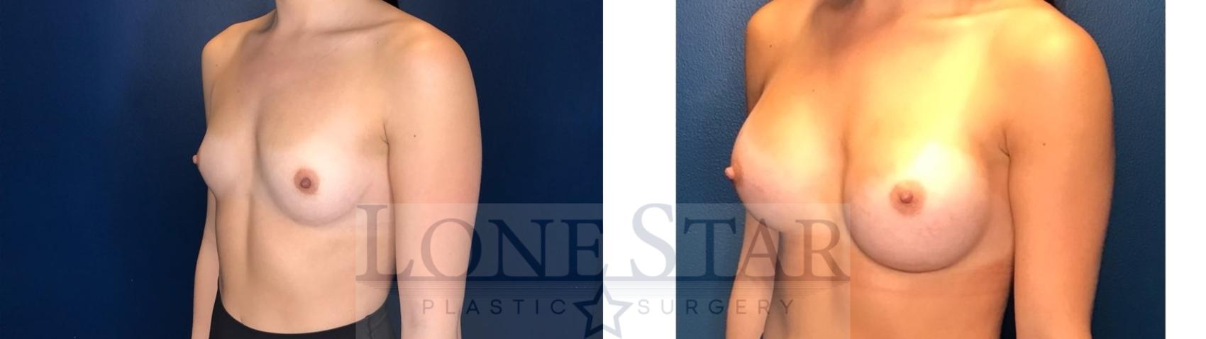 Before & After Breast Augmentation Case 128 Left Oblique View in Frisco, TX