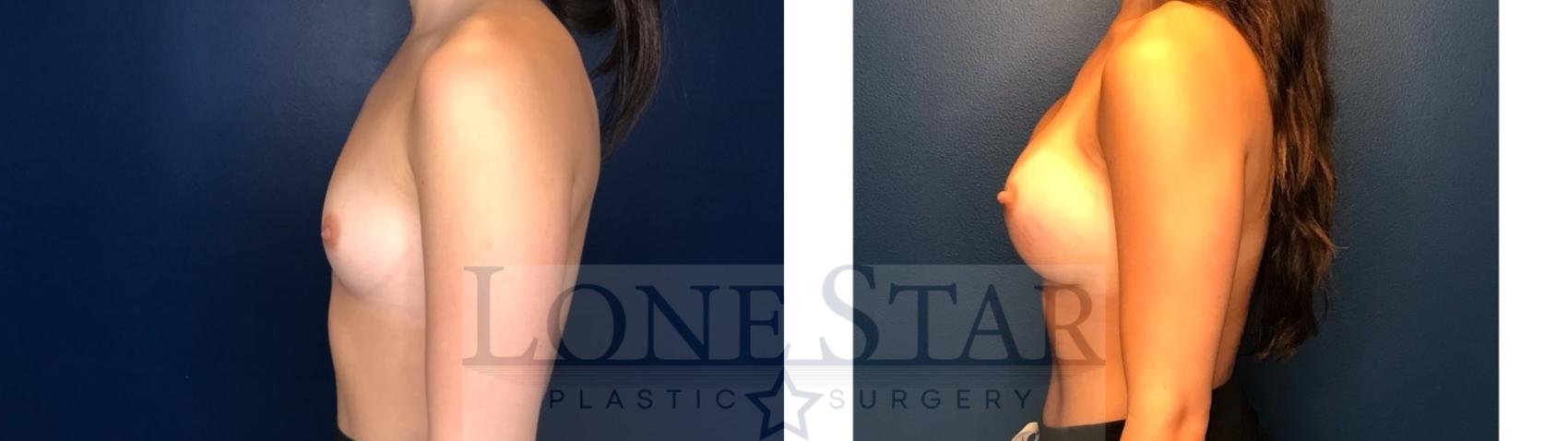 Before & After Breast Augmentation Case 128 Left Side View in Frisco, TX