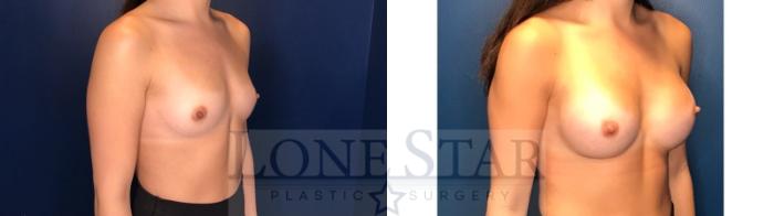 Before & After Breast Augmentation Case 128 Right Oblique View in Frisco, TX
