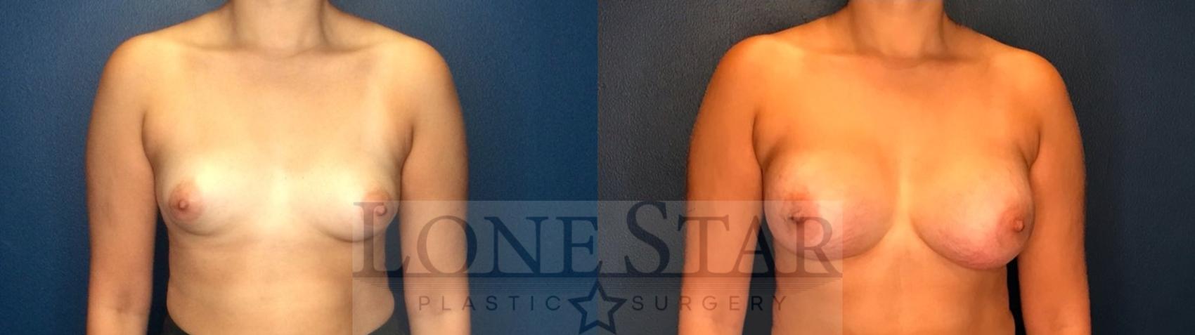 Before & After Breast Augmentation Case 130 Front View in Frisco, TX