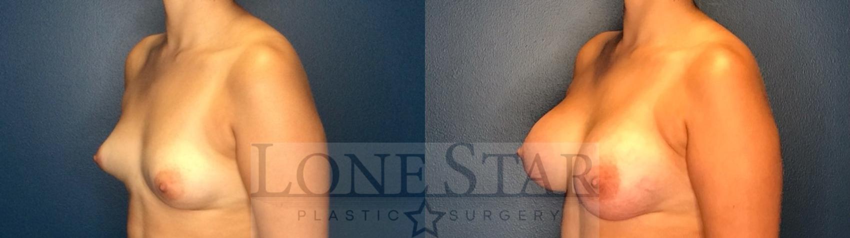Before & After Breast Augmentation Case 130 Left Oblique View in Frisco, TX