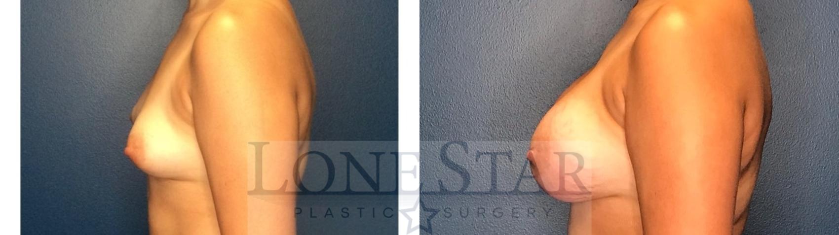 Before & After Breast Augmentation Case 130 Left Side View in Frisco, TX