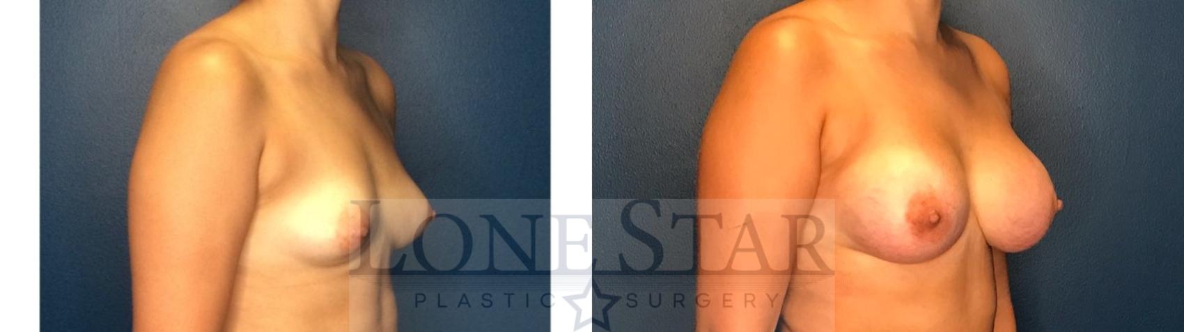 Before & After Breast Augmentation Case 130 Right Oblique View in Frisco, TX