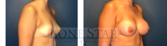 Before & After Breast Augmentation Case 130 Right Oblique View in Frisco, TX