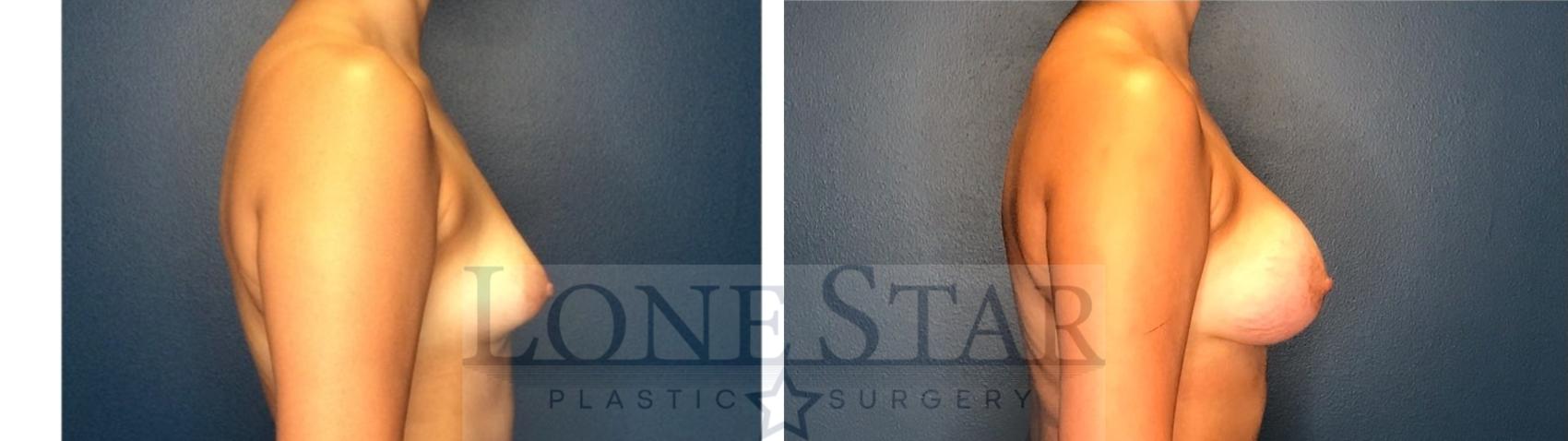 Before & After Breast Augmentation Case 130 Right Side View in Frisco, TX