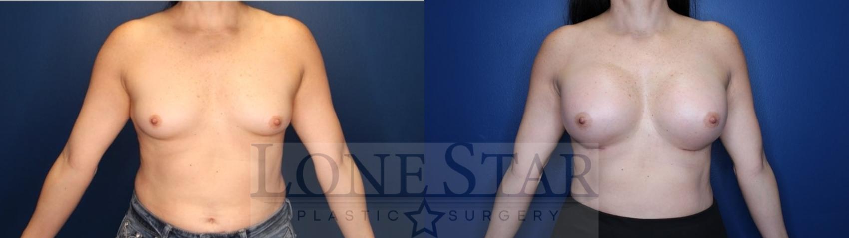 Before & After Breast Augmentation Case 132 Front View in Frisco, TX