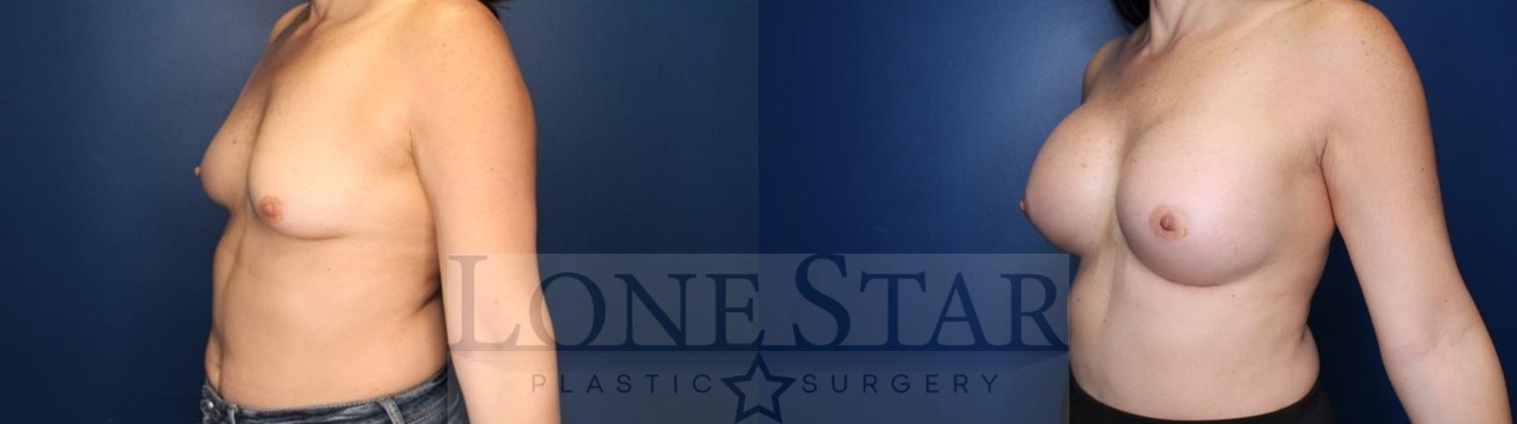 Before & After Breast Augmentation Case 132 Left Oblique View in Frisco, TX