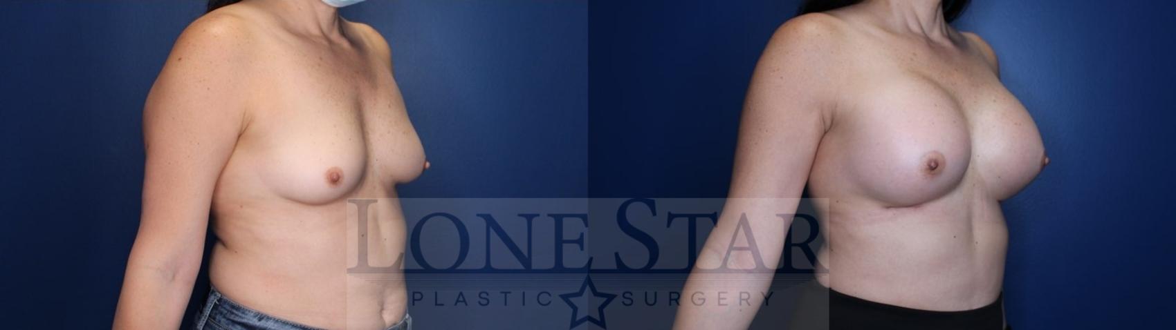 Before & After Breast Augmentation Case 132 Right Oblique View in Frisco, TX