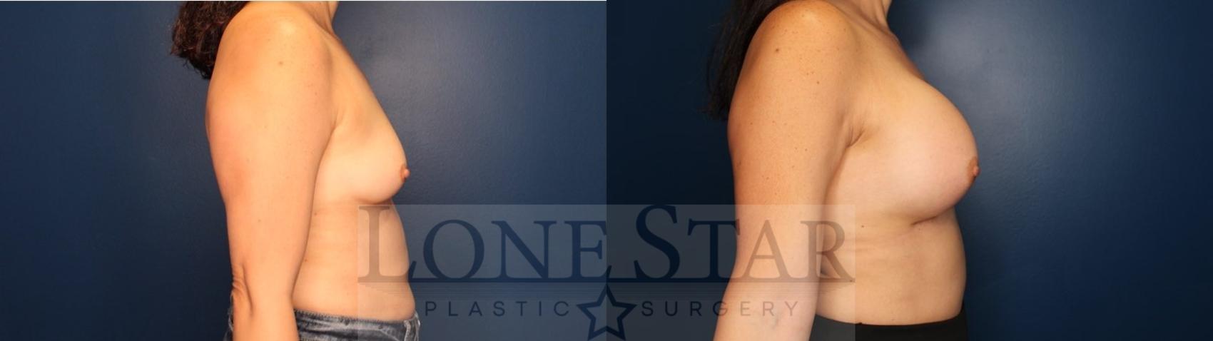 Before & After Breast Augmentation Case 132 Right Side View in Frisco, TX