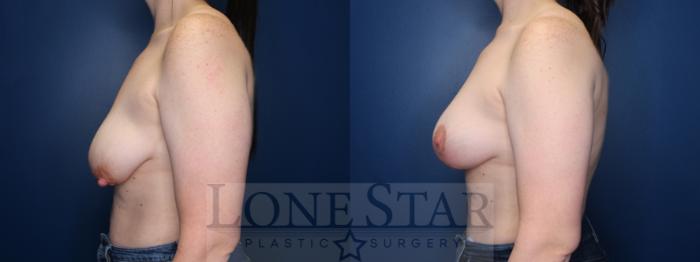 Before & After Breast Augmentation Case 138 Left Side View in Frisco, TX