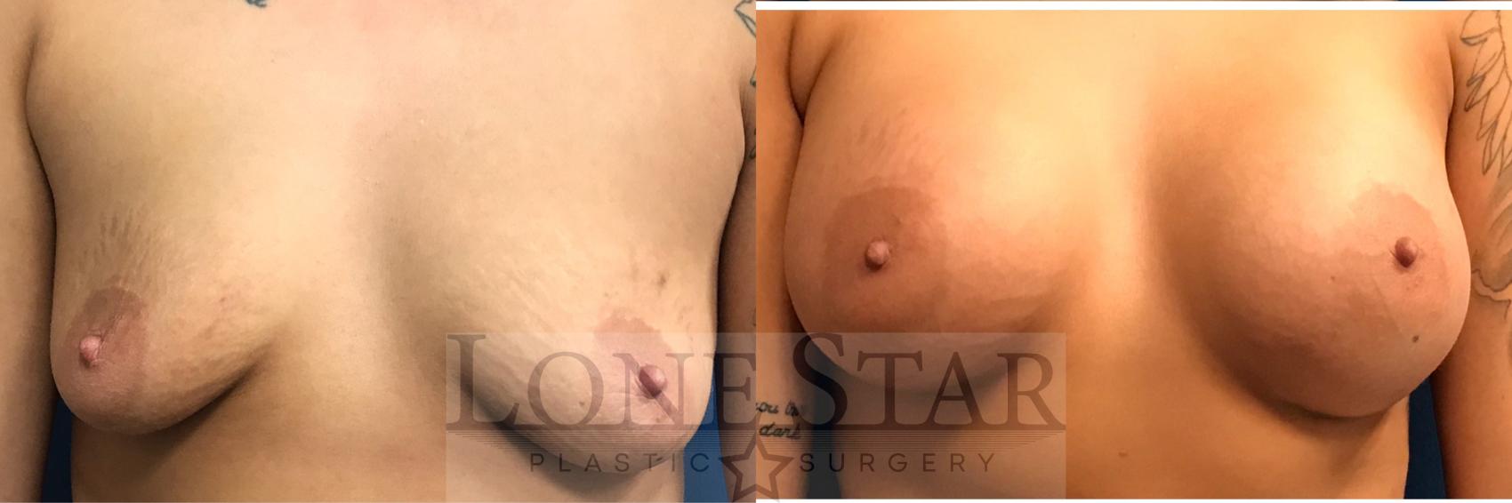 Before & After Breast Augmentation Case 14 View #1 View in Frisco, TX