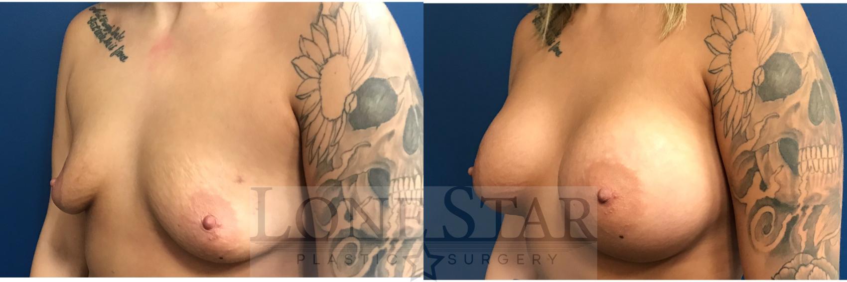 Before & After Breast Augmentation Case 14 View #2 View in Frisco, TX