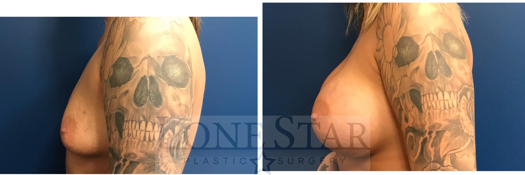 Before & After Breast Augmentation Case 14 View #3 View in Frisco, TX