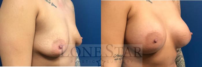Before & After Breast Augmentation Case 14 View #4 View in Frisco, TX