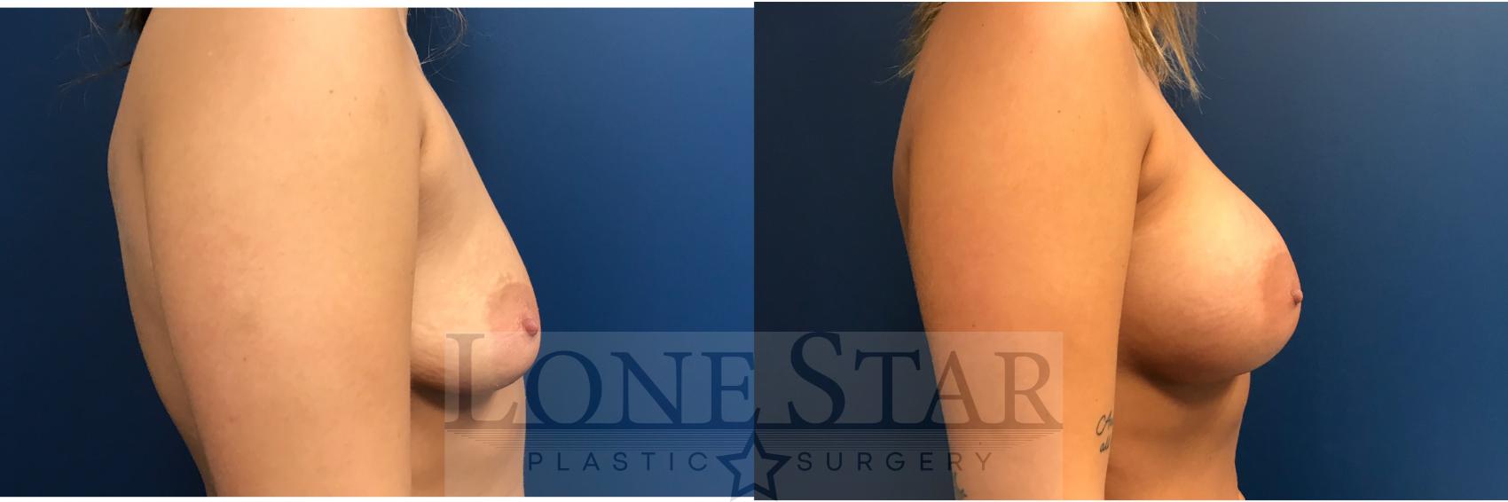 Before & After Breast Augmentation Case 14 View #5 View in Frisco, TX