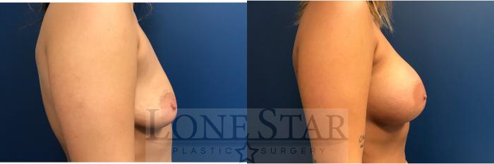 Before & After Breast Augmentation Case 14 View #5 View in Frisco, TX