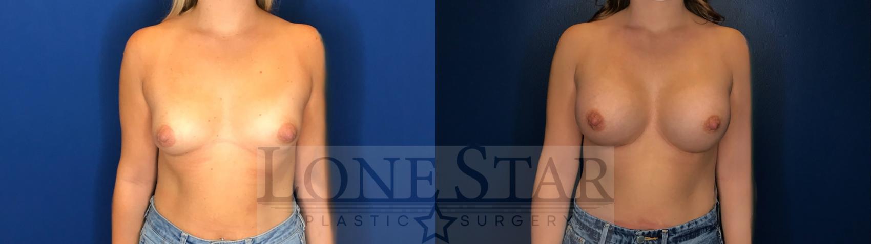 Before & After Breast Augmentation Case 141 Front View in Frisco, TX