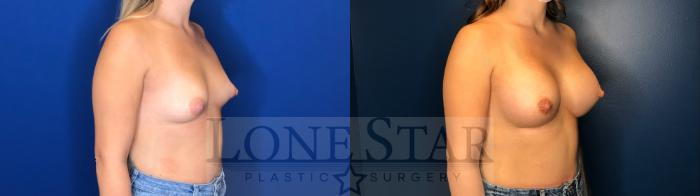 Before & After Breast Augmentation Case 141 Right Oblique View in Frisco, TX