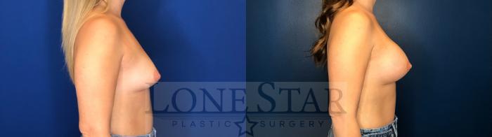 Before & After Breast Augmentation Case 141 Right Side View in Frisco, TX