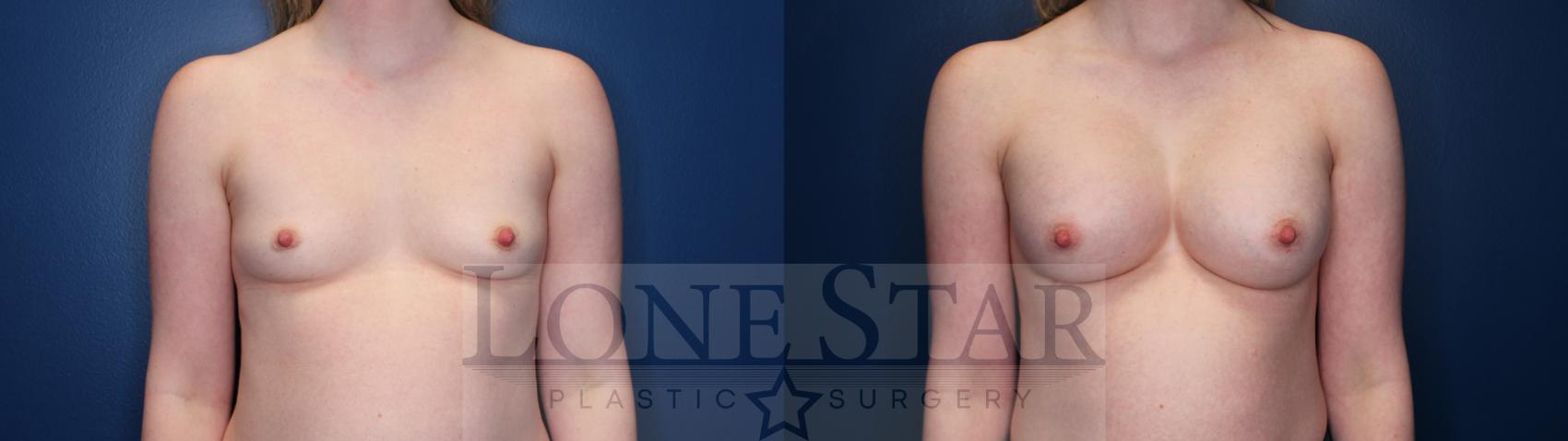 Before & After Breast Augmentation Case 145 Front View in Frisco, TX