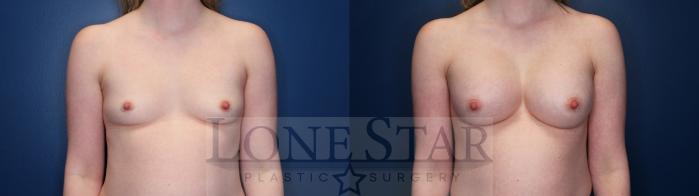 Before & After Breast Augmentation Case 145 Front View in Frisco, TX