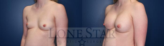 Before & After Breast Augmentation Case 145 Left Oblique View in Frisco, TX