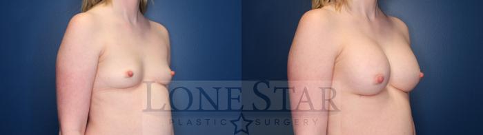 Before & After Breast Augmentation Case 145 Right Oblique View in Frisco, TX