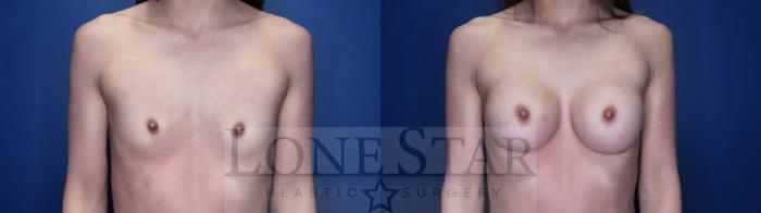 Before & After Breast Augmentation Case 146 Right Side View in Frisco, TX